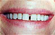 Veneers Before