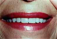 Veneers After