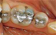 Tooth Healing Before