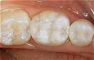 Tooth Healing After