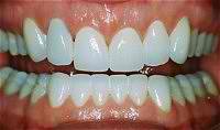 Veneers After