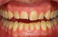 Dentures Before