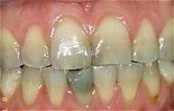 Dentures Before