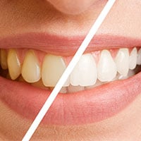 Remove Any Stain From Your Teeth At Our Gilbert Denal Office