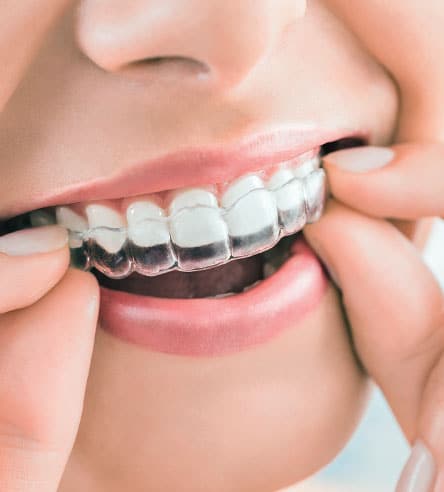 Affordable Invisalign Braces Near You