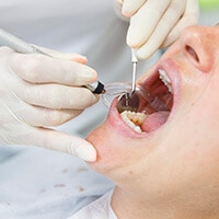 Our Inlays & Onlays Dental Procedure Start With Removing The Damaged Part