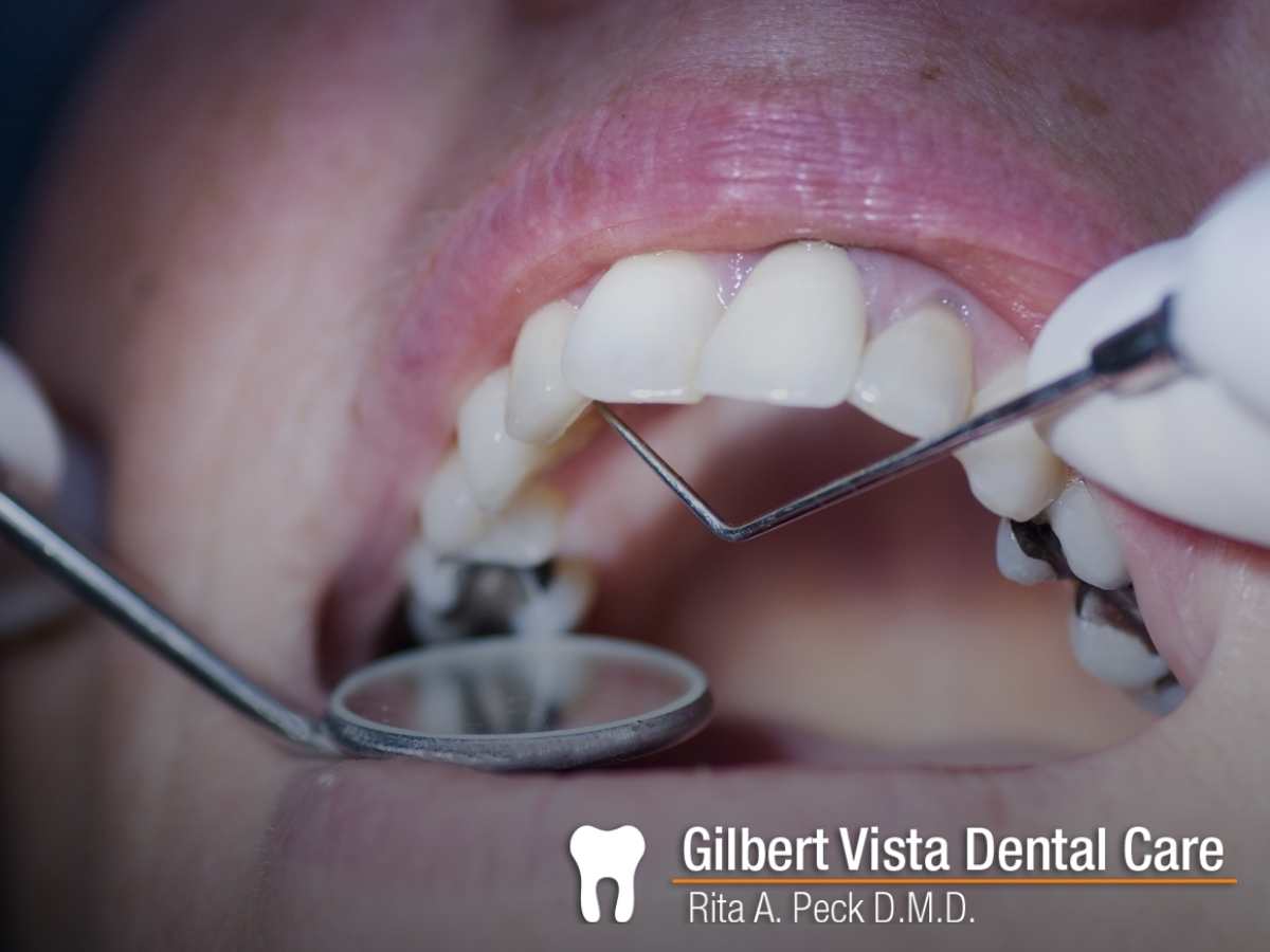 Professional Dental Filling Procedure In Gilbert, AZ