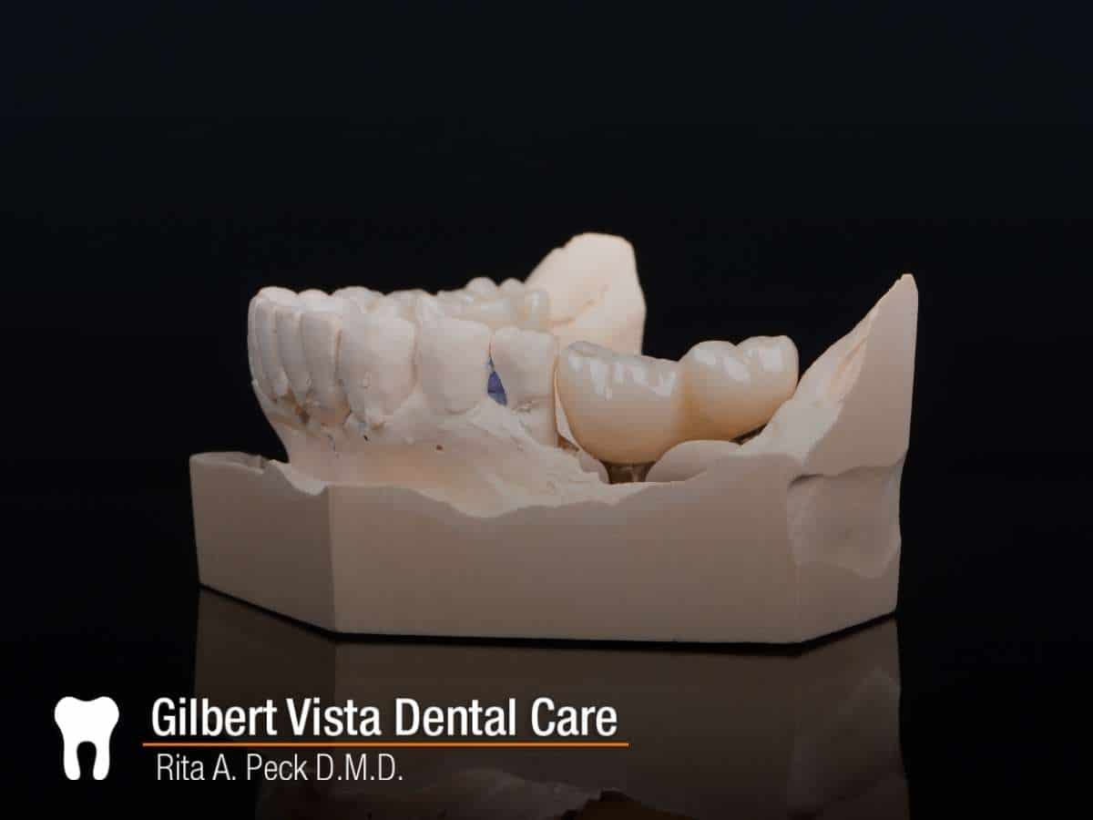 Zirconia Dental Crowns: Advantages, Disadvantages & Types In Gilbert, AZ
