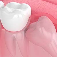 Emergency Wisdom Tooth Removal In Gilbert