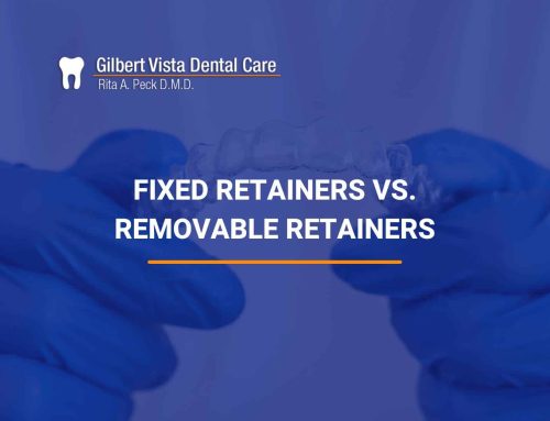Fixed Retainers vs. Removable Retainers