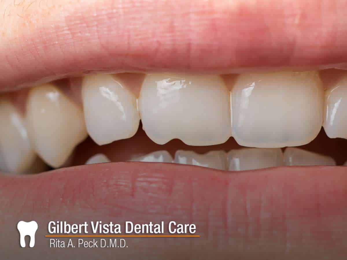 A patient with a cracked tooth in Gilbert, AZ