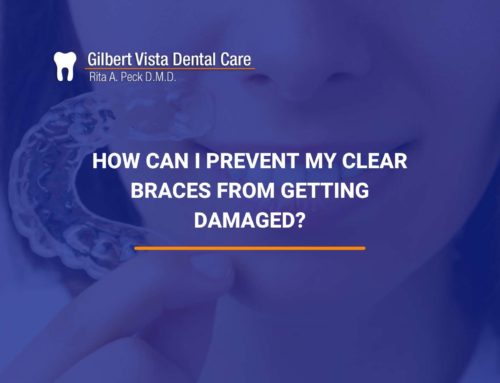 How Can I Prevent My Clear Braces From Getting Damaged?