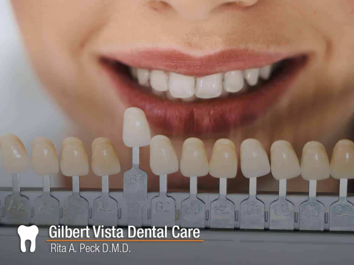 Close-up of a smile with veneers compared to a shade guide for Gilbert Vista Dental Care