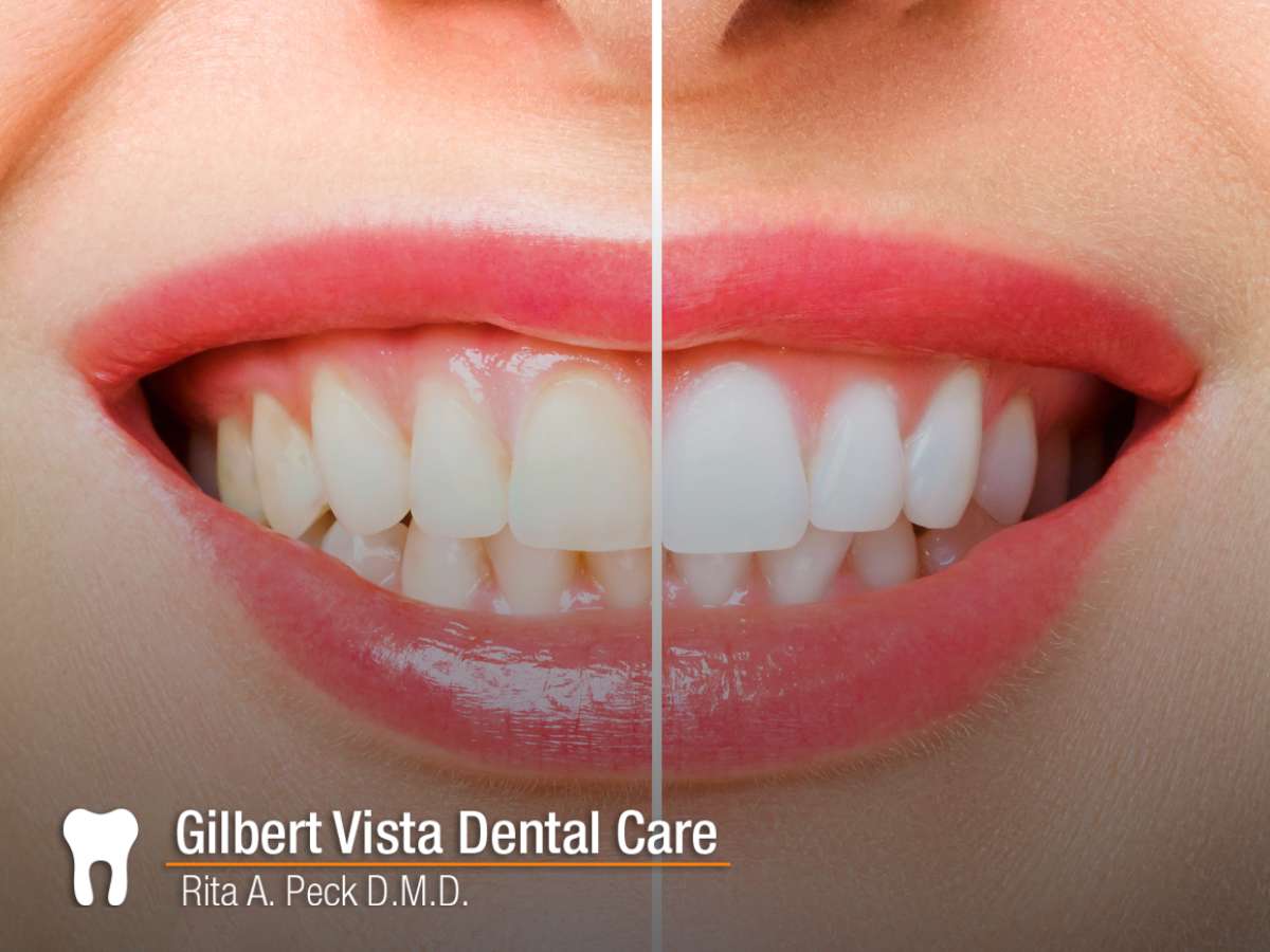 Before and after teeth whitening comparison by Gilbert Vista Dental Care, showcasing a significant improvement in tooth brightness
