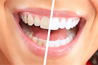 Cosmetic Dentistry including teeth whitening in Gilbert, AZ